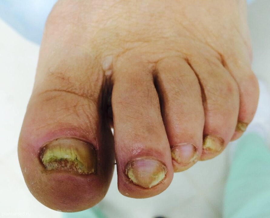 advanced nail fungus