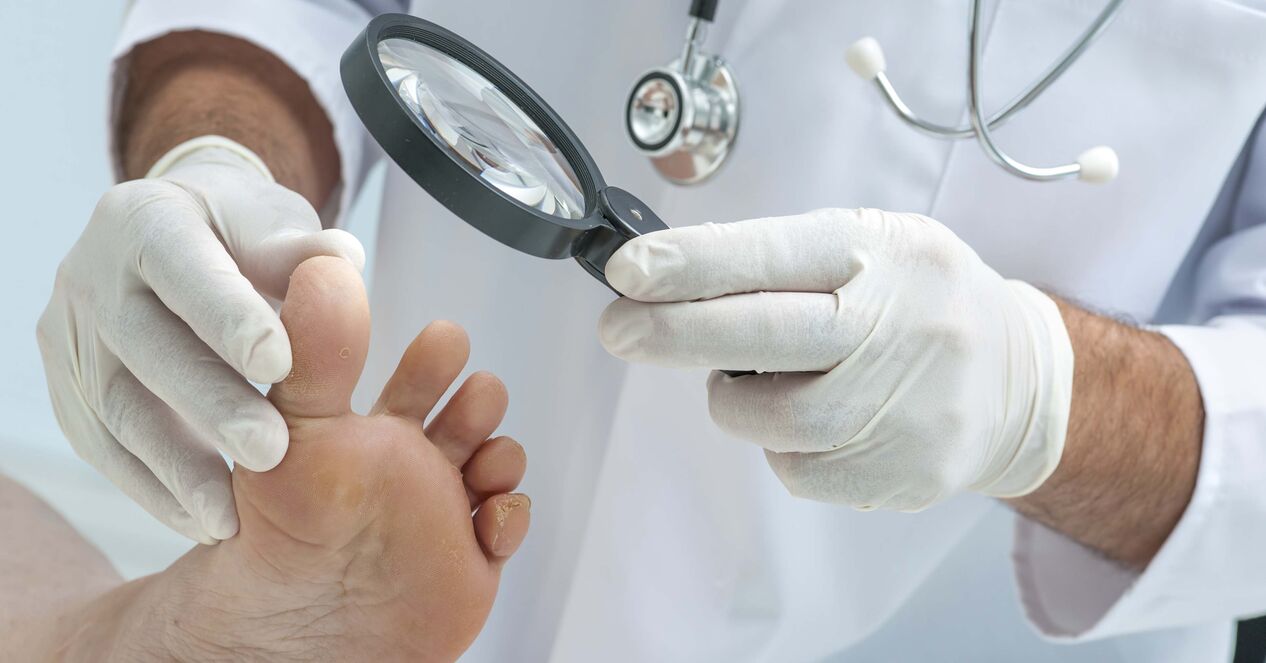 the doctor examines the feet for nail fungus