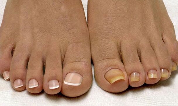 Healthy toenails (left) and those affected by fungus (right)