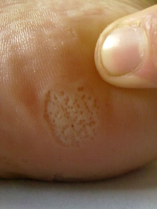 Manifestations of toenail fungus