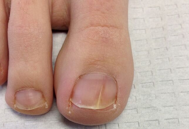 Visual manifestations of toenail fungus in the initial stage