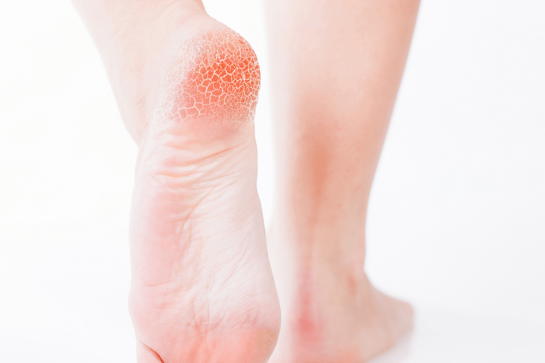 treatment of athlete's foot in the early stage