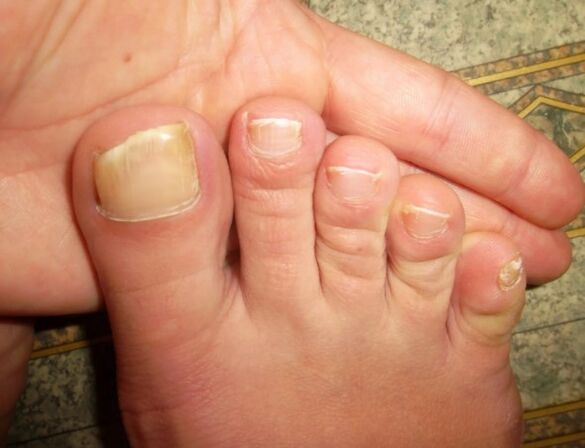 Mushrooms on a large nail