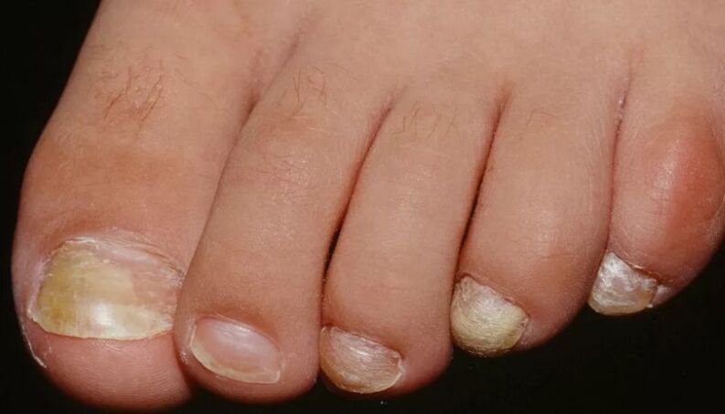 Nails of nails on the thumb