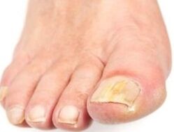 After the bath, the affected nail is easier to remove