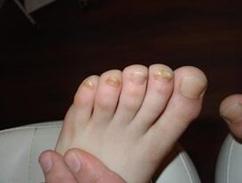 Nail fungus occurs in children too