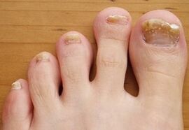 Onychomycosis turned