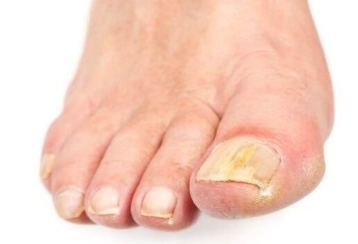 Fungi on the nails