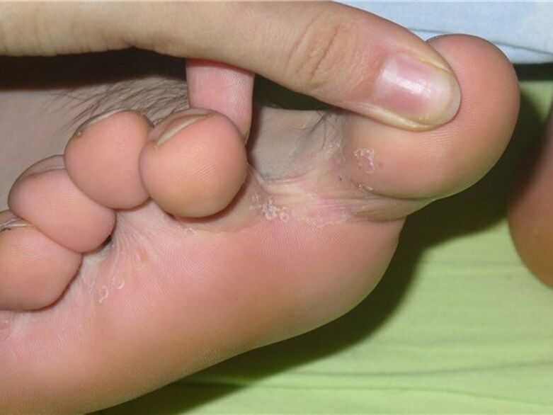 Fungi between fingers
