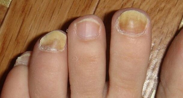 Changing the color and structure of the nails