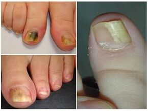 What looks like mushrooms on nails