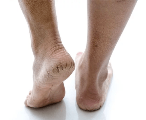 The fungus on the stopping skin