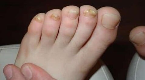 Almost all fingers are affected by fungi