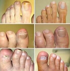 Deformity of the nail