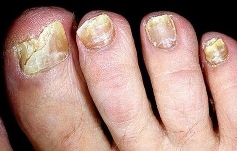 Nails crumble from fungi