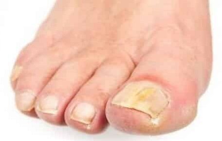 The initial stage of the fungus in the nail of the foot
