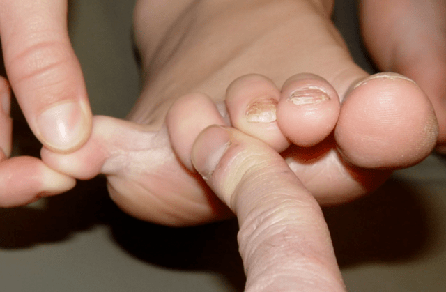 Fungi between fingers