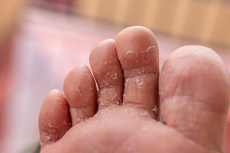 Fungi between fingers
