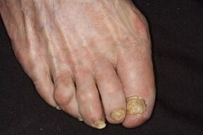 Treatment of nail fungus in the legs of apple cider vinegar