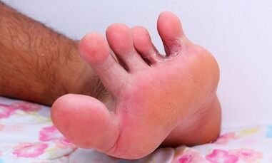 Causes of fungi between fingers