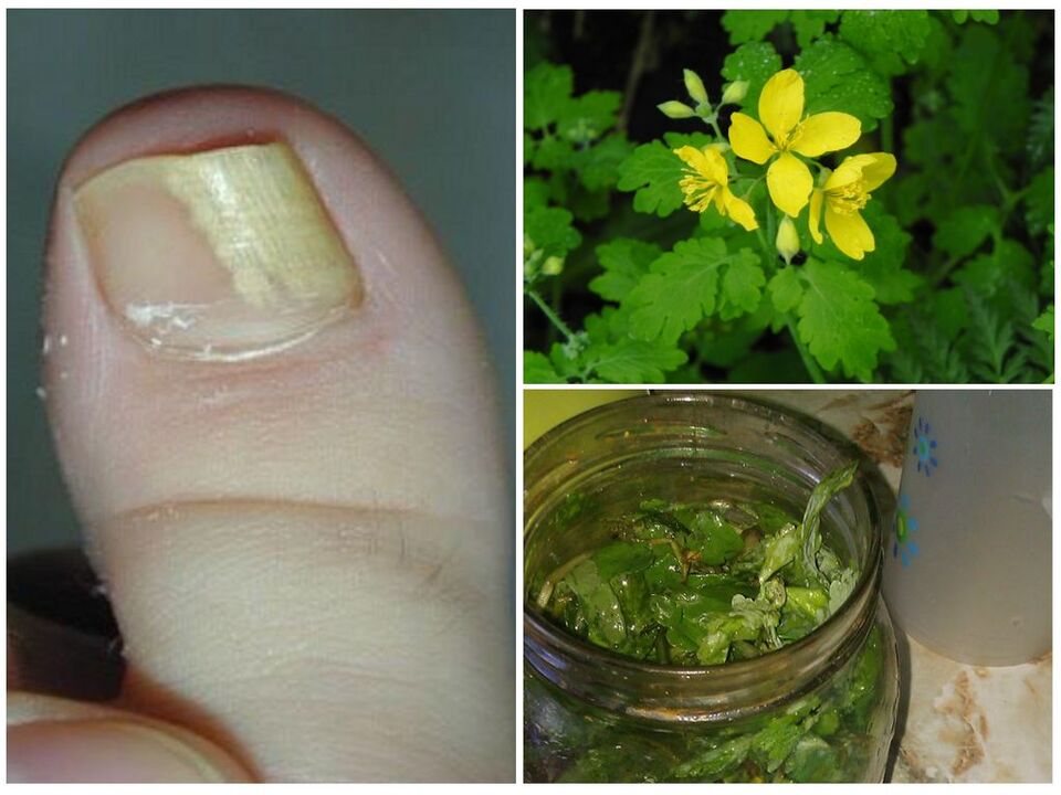 celandine for nail fungus