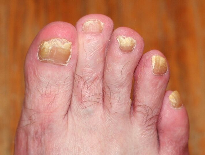 advanced form of nail fungus