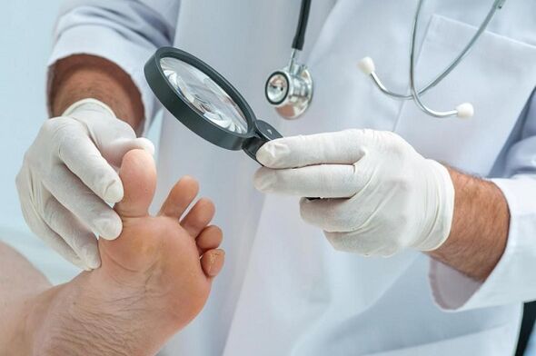 Causes and treatment of toenail fungus