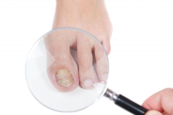 stages and stages of the development of toenail fungus