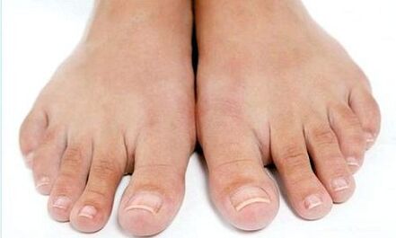 Treatment of interdigital fungus