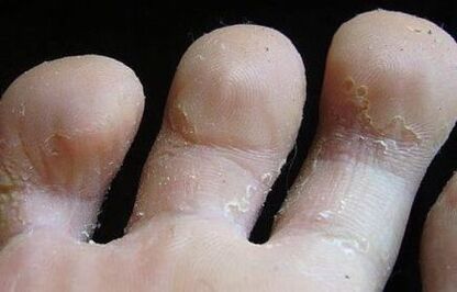 fungus marks between toes