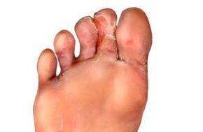 the fungus between the fingers