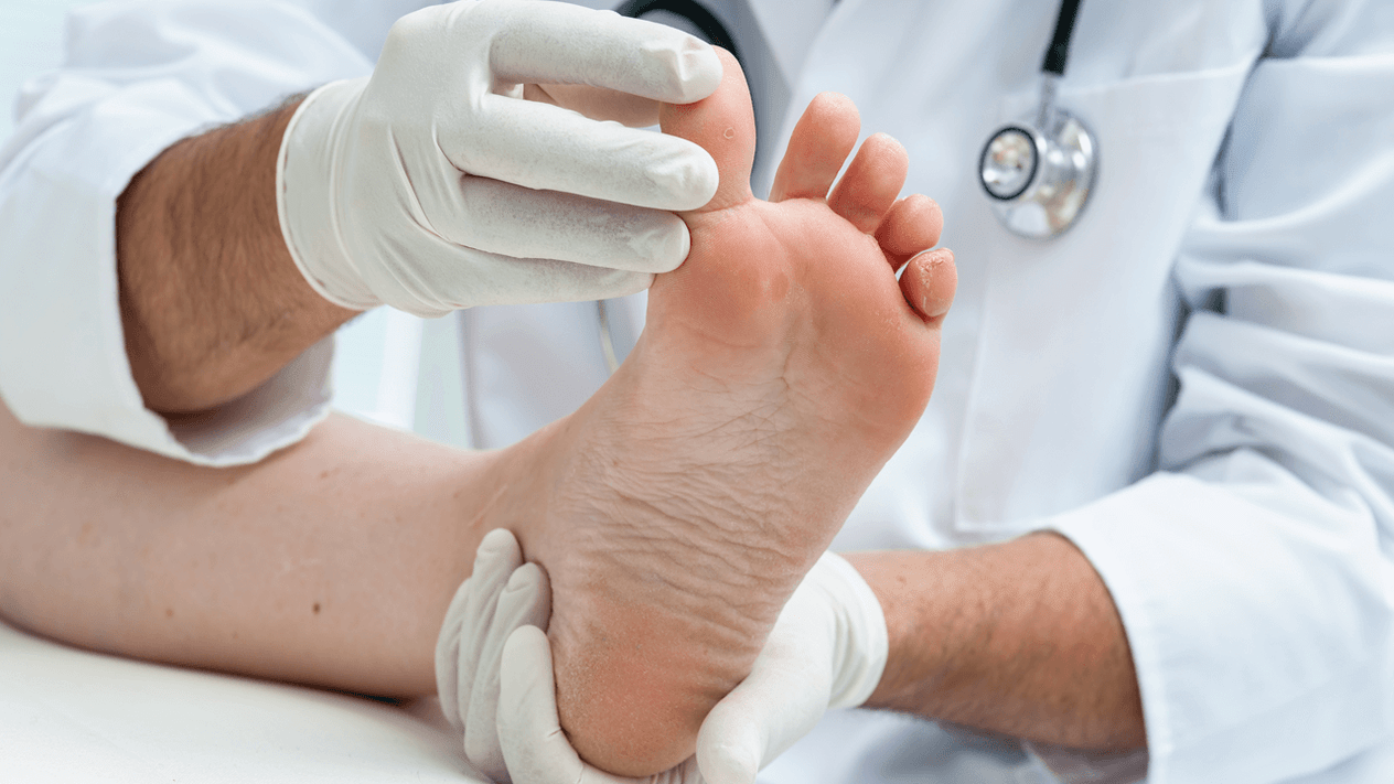 Diagnosis of foot fungus