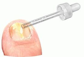 Applying medicated drops to a nail affected by fungus