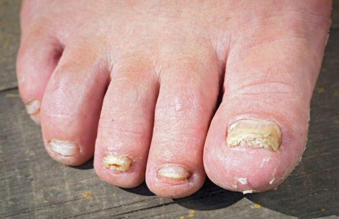 Rubromycosis fungus on the feet