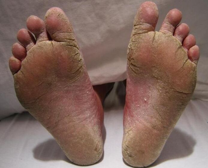 squamous-hyperkeratic fungi on legs