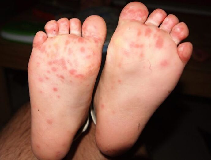 vesicular fungus on foot