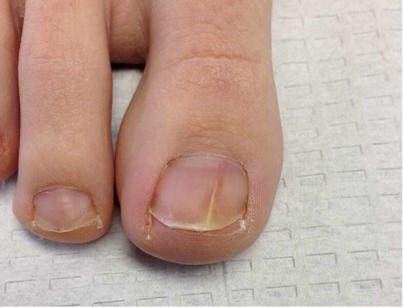Lines and spots on the nail of the thumb during the first stage of fungal development