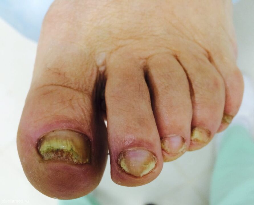 Severe deformation of the toenails is a sign of the third advanced stage of the fungus