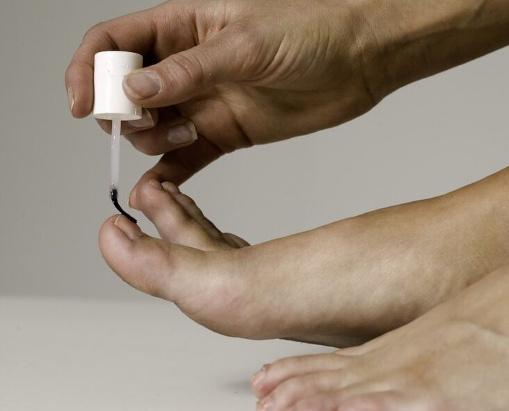 The use of medicinal varnish for the treatment and prevention of onychomycosis in the thumb