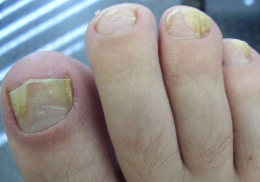 The yellow color of the nail plate in the second stage of fungal infection