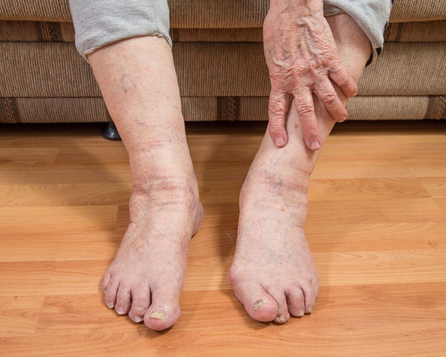 To avoid the spread of fungal microspores, do not walk barefoot in the house.